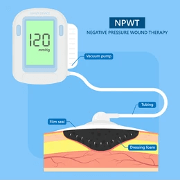 Negative Pressure Wound Therapy at Spark Wound Care