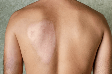 Skin Grafts at Spark Wound Care