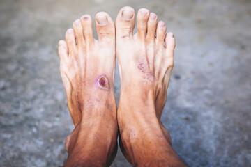 When is a Skin Graft Needed?